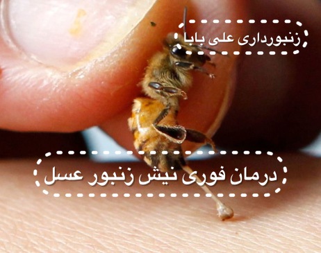 درمان فوری نیش زنبور عسل